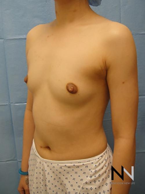 Breast Augmentation: Patient 4 - Before 2