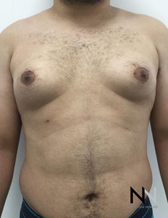 Gynecomastia: Patient 10 - Before Image 1