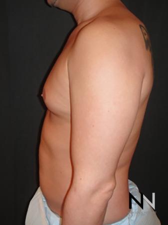 Gynecomastia: Patient 2 - Before Image 4