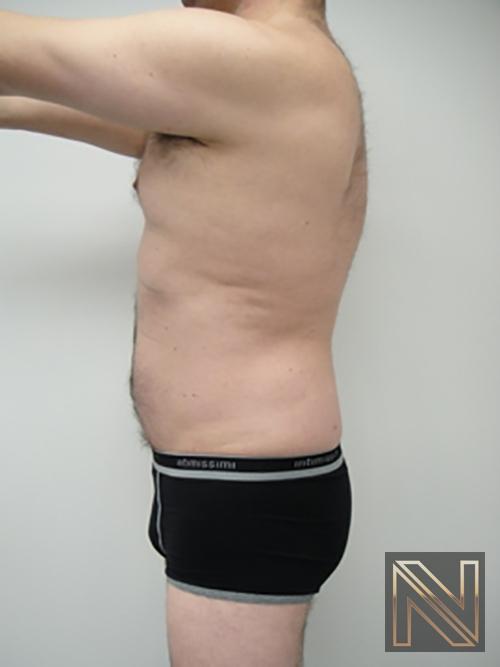 Liposuction: Patient 17 - After 1