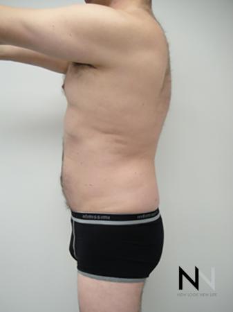 Liposuction: Patient 17 - After Image 1