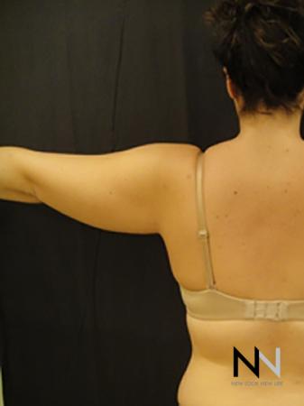 Liposuction: Patient 25 - Before Image 1