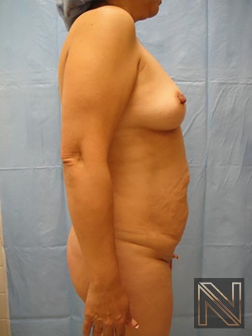 Abdominoplasty: Patient 20 - Before and After 3