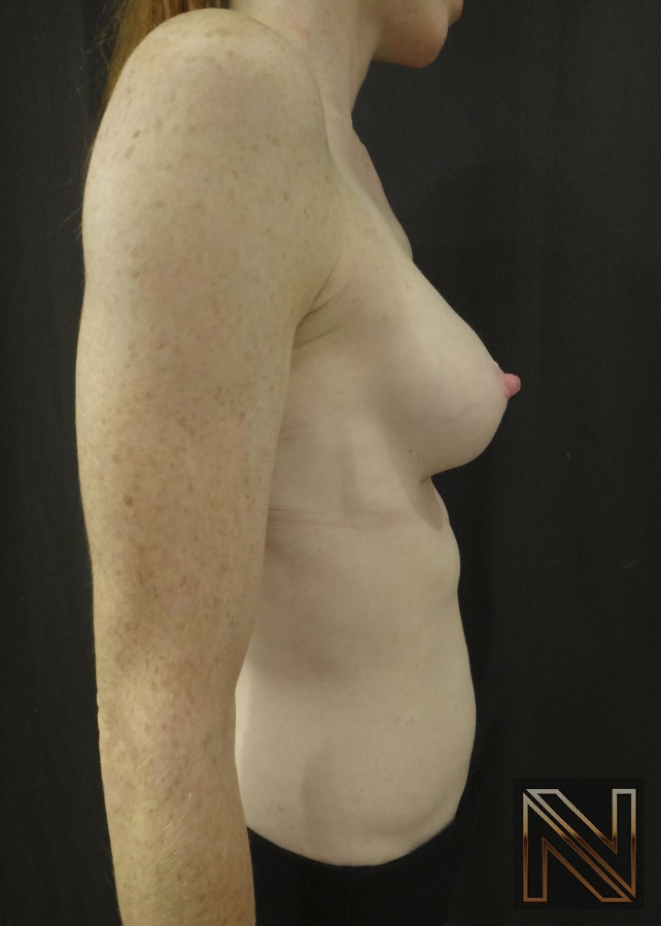 Breast Augmentation: Patient 17 - After 4