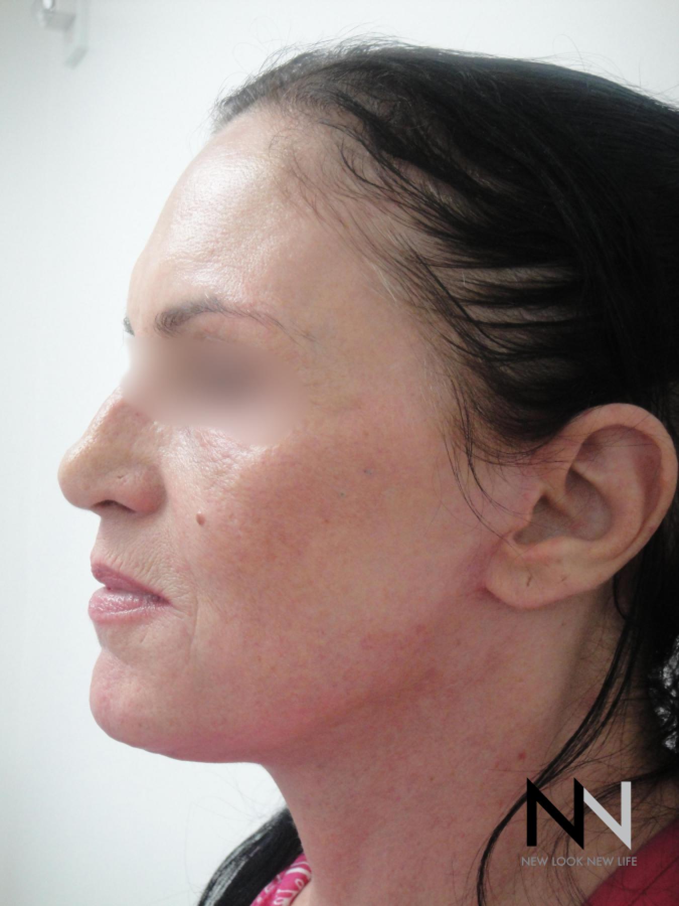 Fractional Resurfacing: Patient 1 - After 1