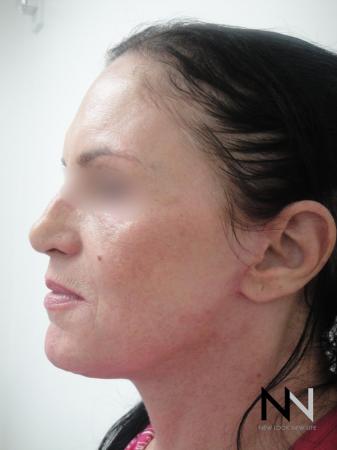 Fractional Resurfacing: Patient 1 - After Image 1