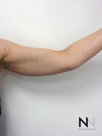 Liposuction: Patient 26 - Before and After Image 2