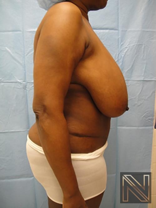 Breast Reduction: Patient 4 - Before and After 5