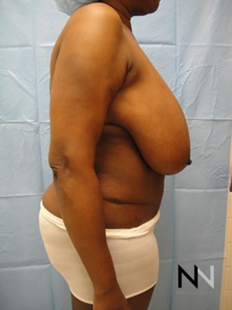 Breast Reduction: Patient 4 - Before and After Image 5
