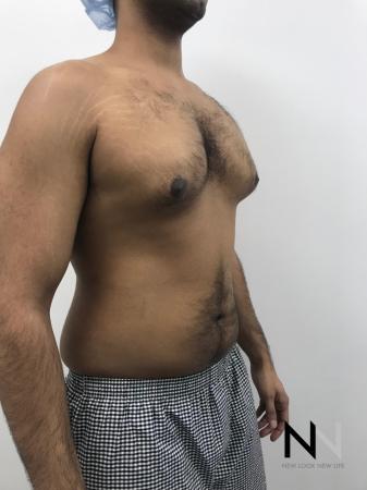 Gynecomastia: Patient 7 - Before Image 4