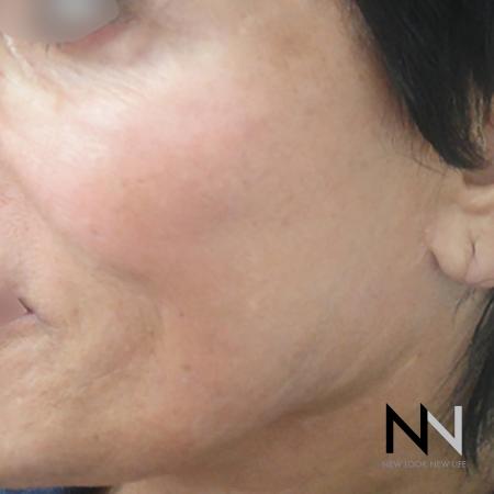 Halo™: Patient 4 - After Image 1