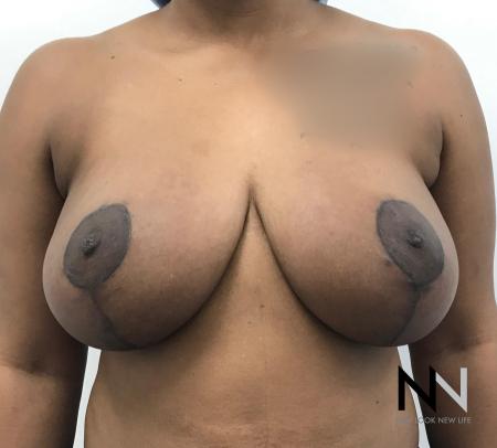 Breast Lift: Patient 14 - After Image 1