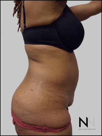Mini Tummy Tuck: Patient 3 - Before Image 2