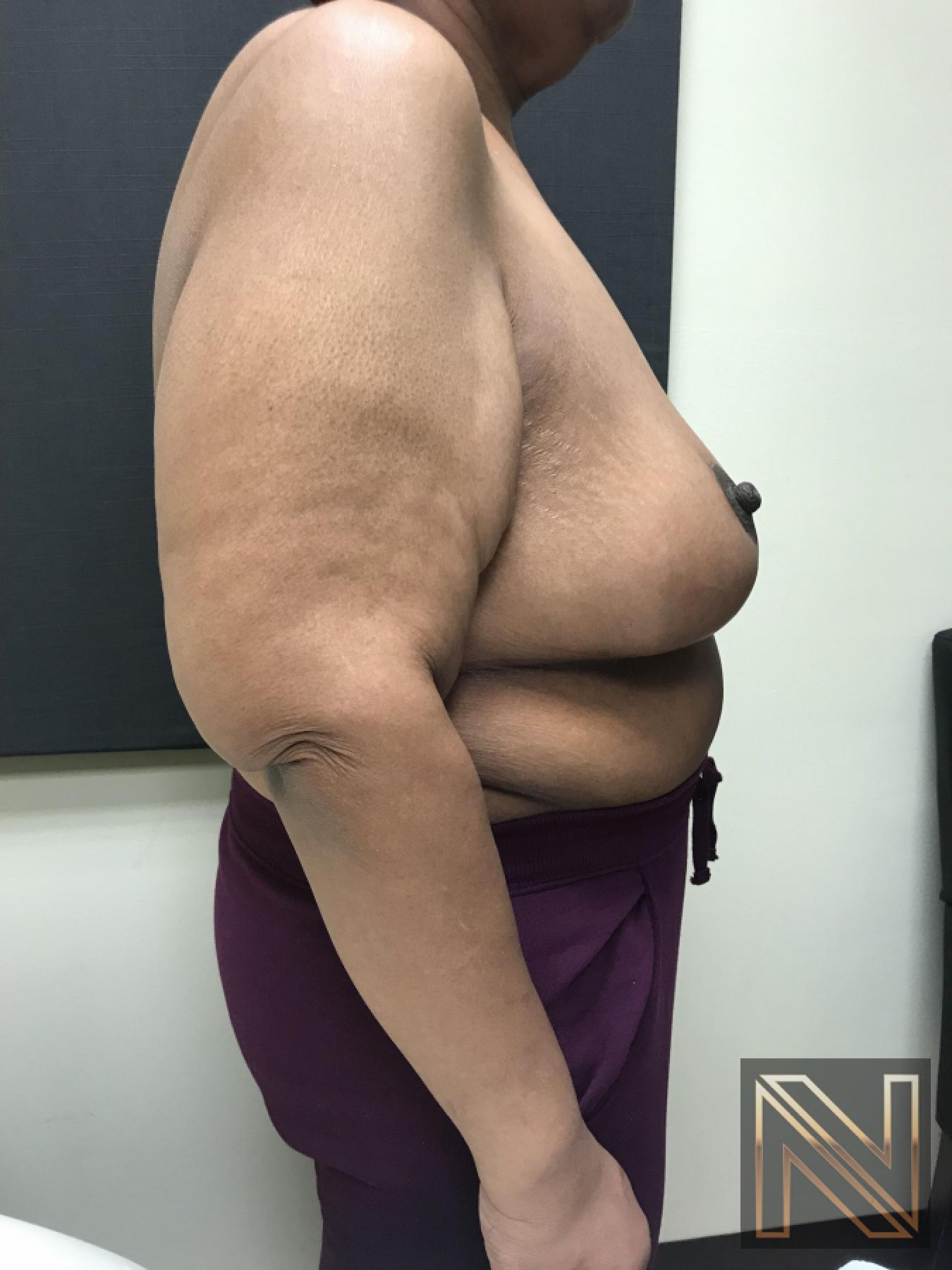 Breast Reduction: Patient 2 - After 2