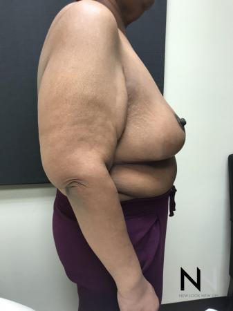 Breast Reduction: Patient 2 - After Image 2