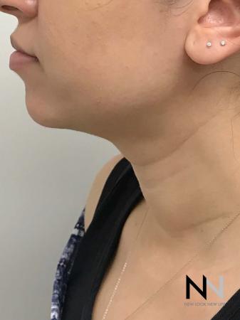 Liposuction: Patient 2 - After Image 4
