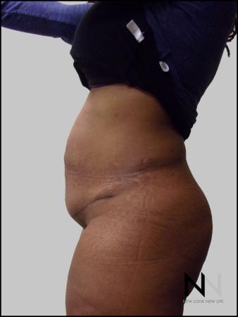 Mini Tummy Tuck: Patient 3 - After Image 3