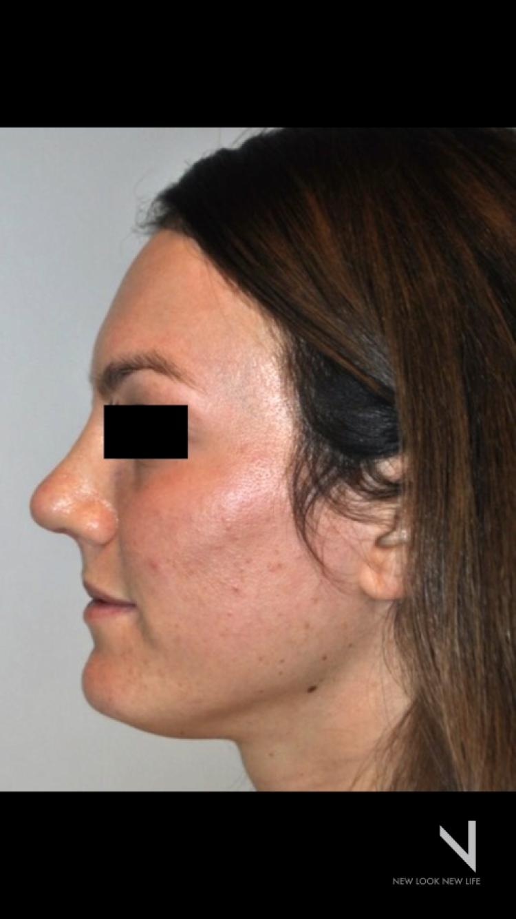 Rhinoplasty: Patient 2 - After  