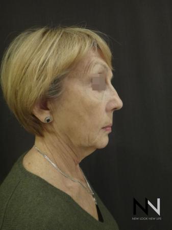 Ultherapy®: Patient 2 - Before Image 3