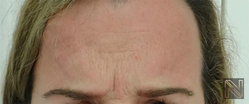 BOTOX® Cosmetic: Patient 2 - Before 1