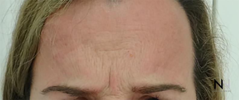 BOTOX® Cosmetic: Patient 2 - Before 