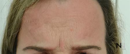 BOTOX® Cosmetic: Patient 2 - Before Image 1