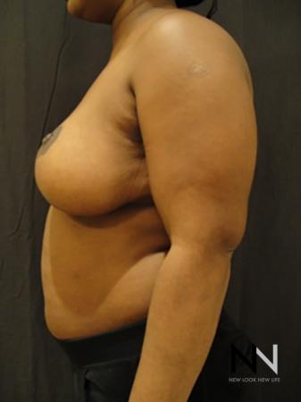 Breast Reduction: Patient 3 - After Image 4