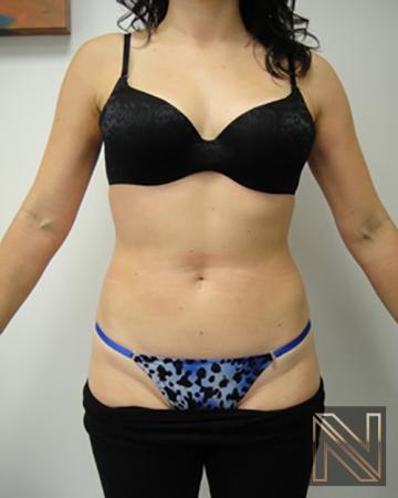 Liposuction: Patient 8 - After  