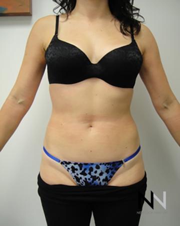 Liposuction: Patient 8 - After Image 1