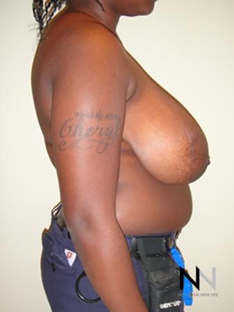 Breast Reduction: Patient 6 - Before and After Image 5