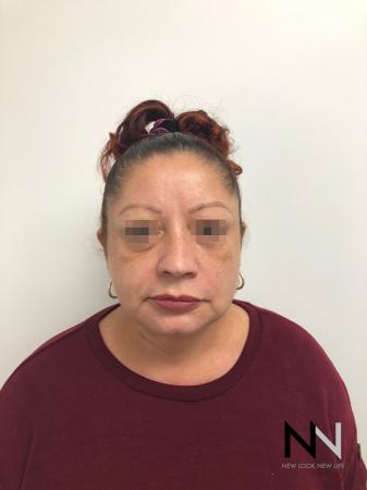 Facelift/Mini Facelift: Patient 2 - After Image 5