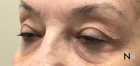 Fractional Resurfacing: Patient 7 - Before Image 1