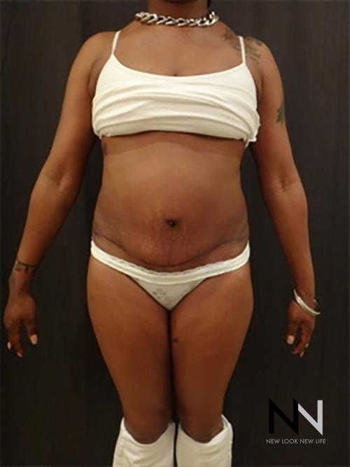 Abdominoplasty: Patient 13 - After 1