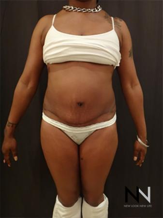 Abdominoplasty: Patient 13 - After 1