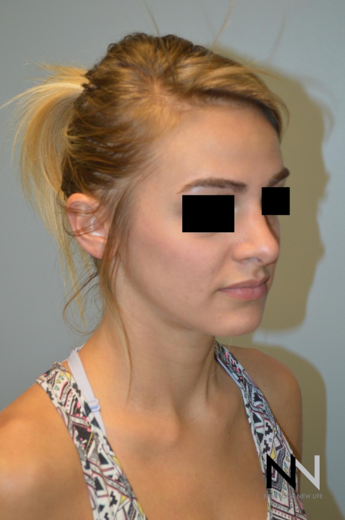 Rhinoplasty: Patient 3 - After 3