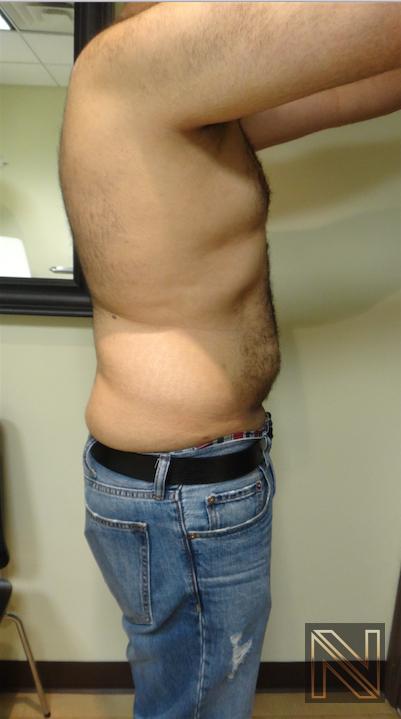 Liposuction: Patient 16 - After 3