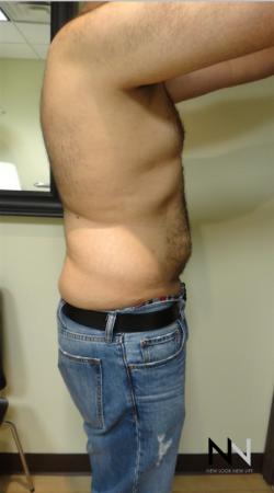 Liposuction: Patient 16 - After Image 3