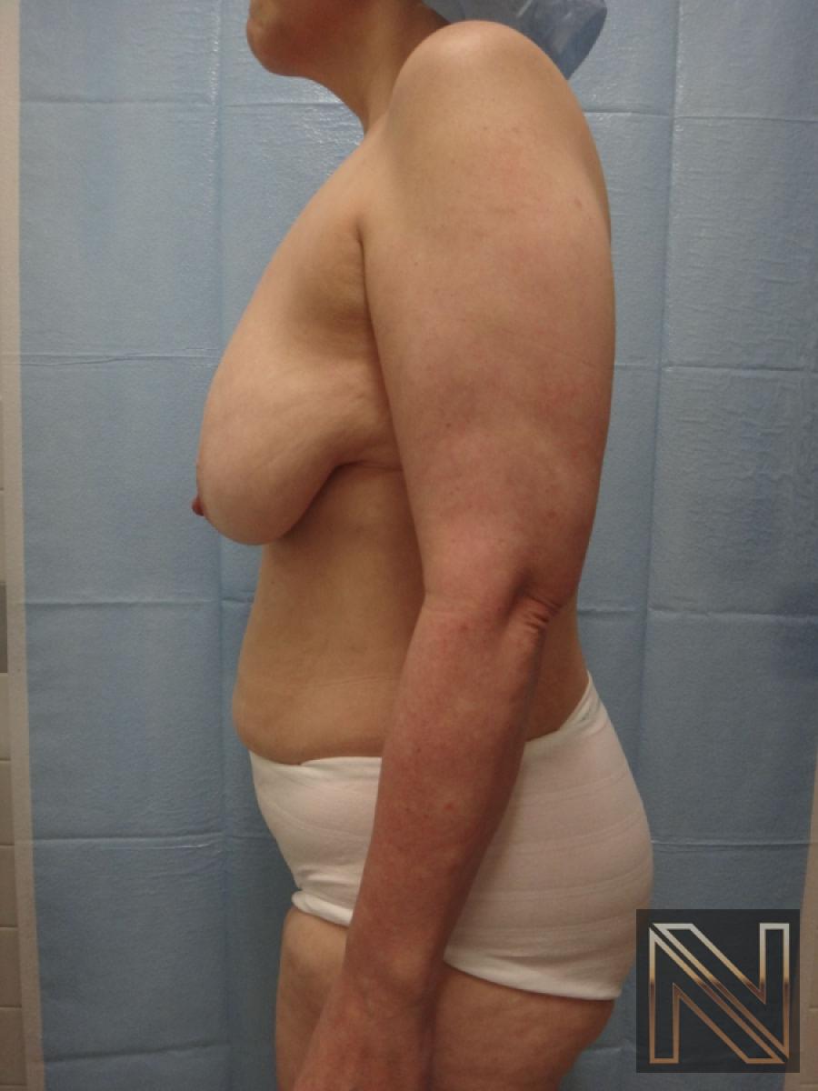 Breast Lift: Patient 3 - Before 4