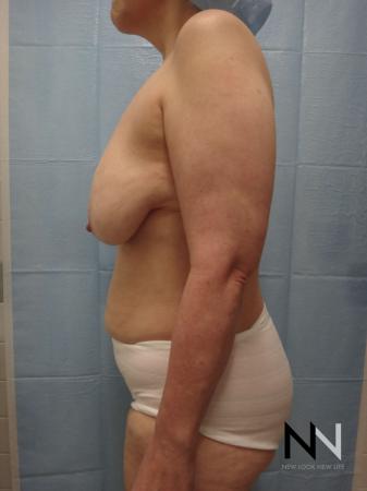Breast Lift: Patient 3 - Before Image 4