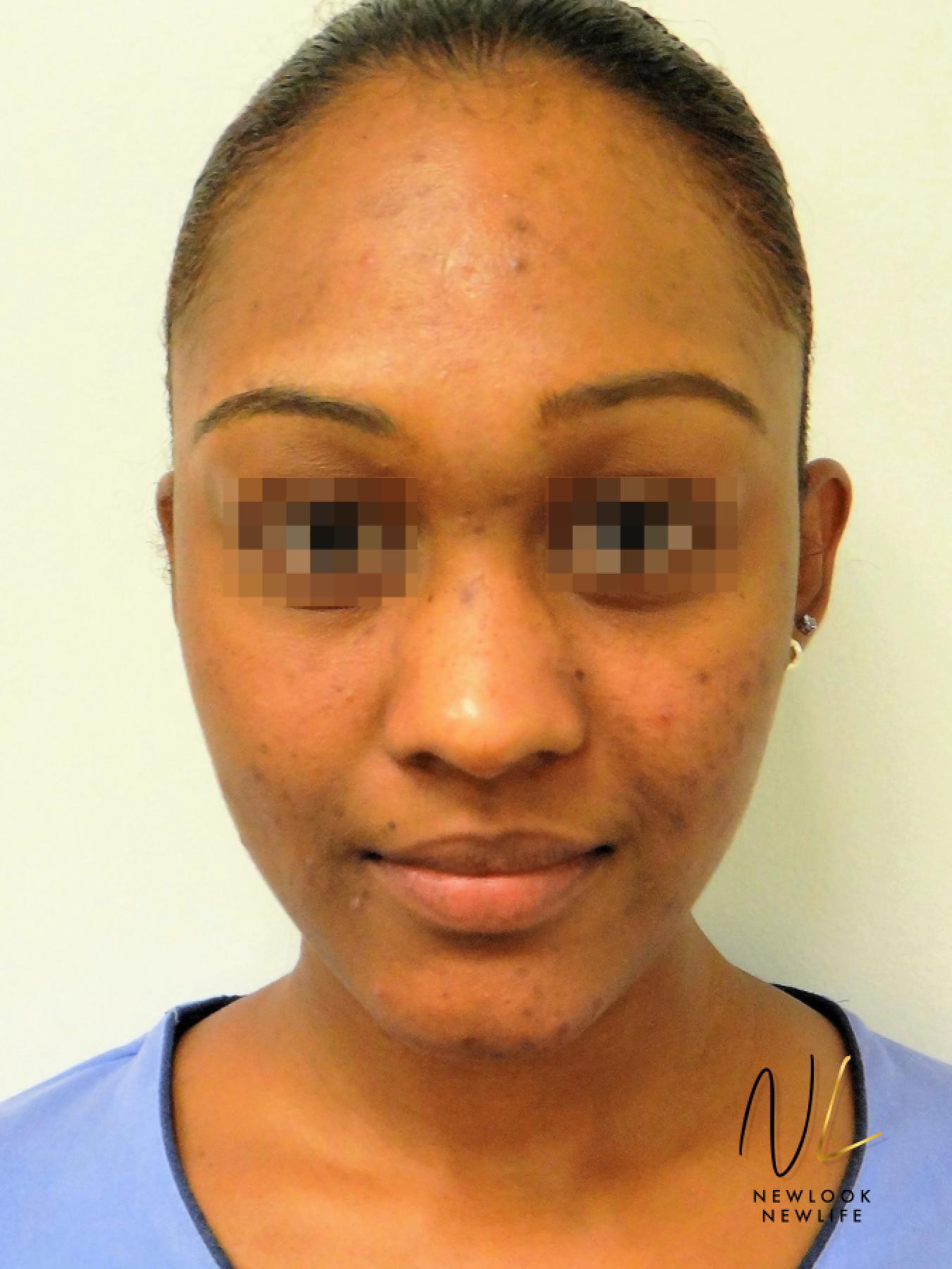 Laser Skin Resurfacing - Face: Patient 4 - After  