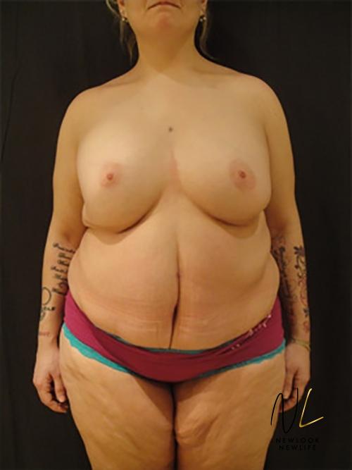 Abdominoplasty: Patient 16 - After 1