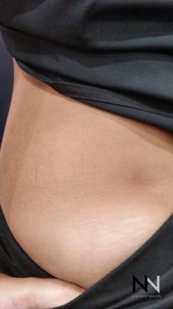 Fractional Resurfacing: Patient 8 - After Image 1