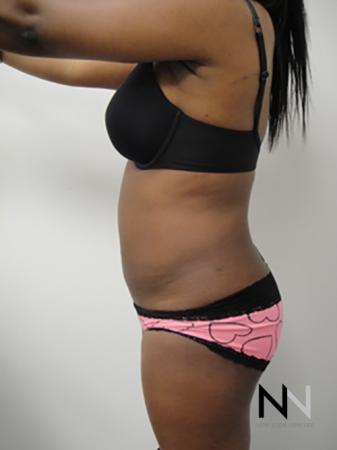 Liposuction: Patient 4 - After Image 2