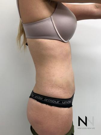 Liposuction: Patient 10 - After Image 2