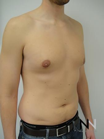 Gynecomastia: Patient 4 - After Image 3