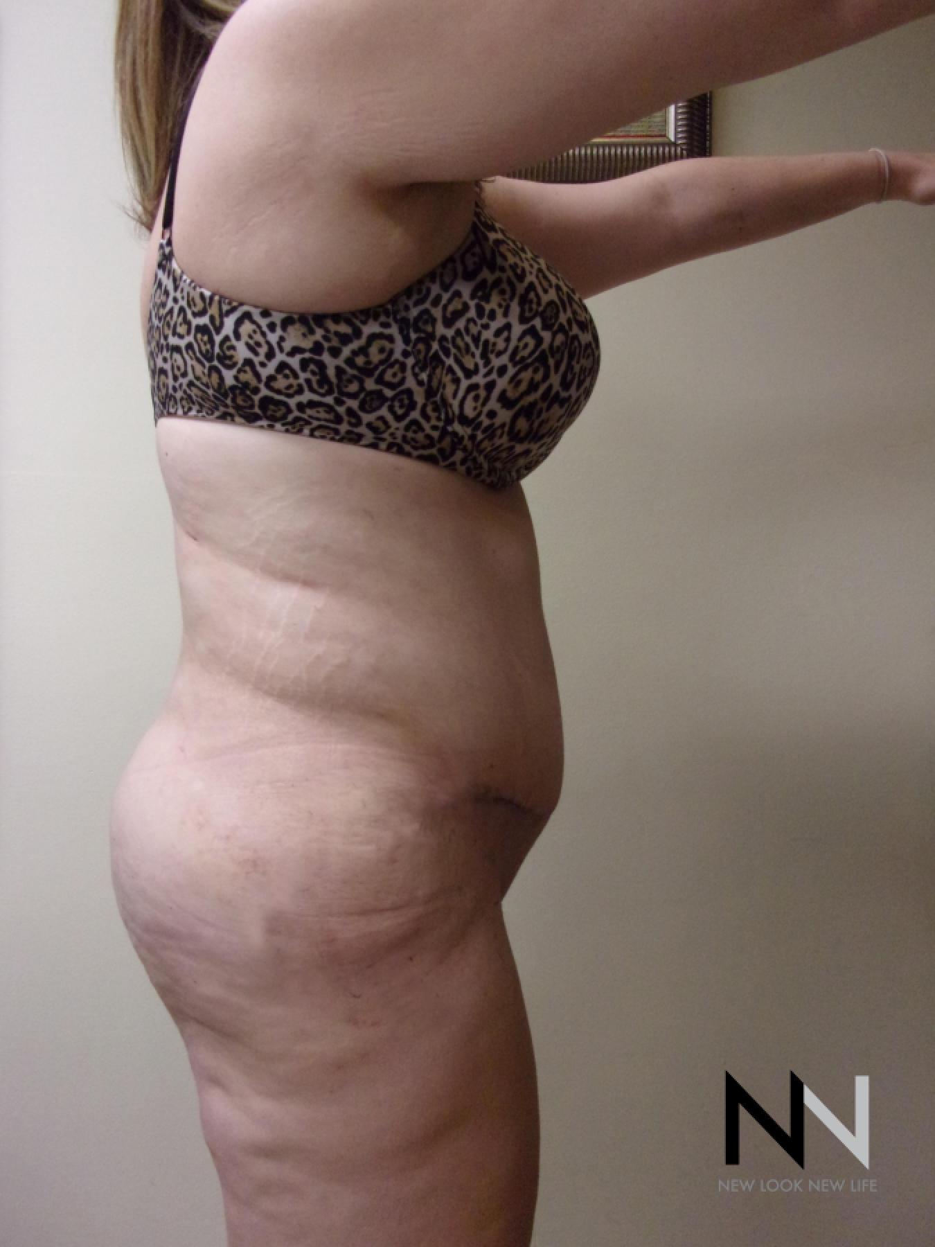 Abdominoplasty: Patient 1 - After 3