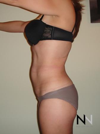Liposuction: Patient 7 - After Image 2