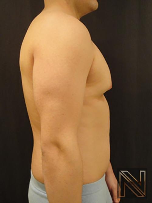 Gynecomastia: Patient 3 - Before and After 5