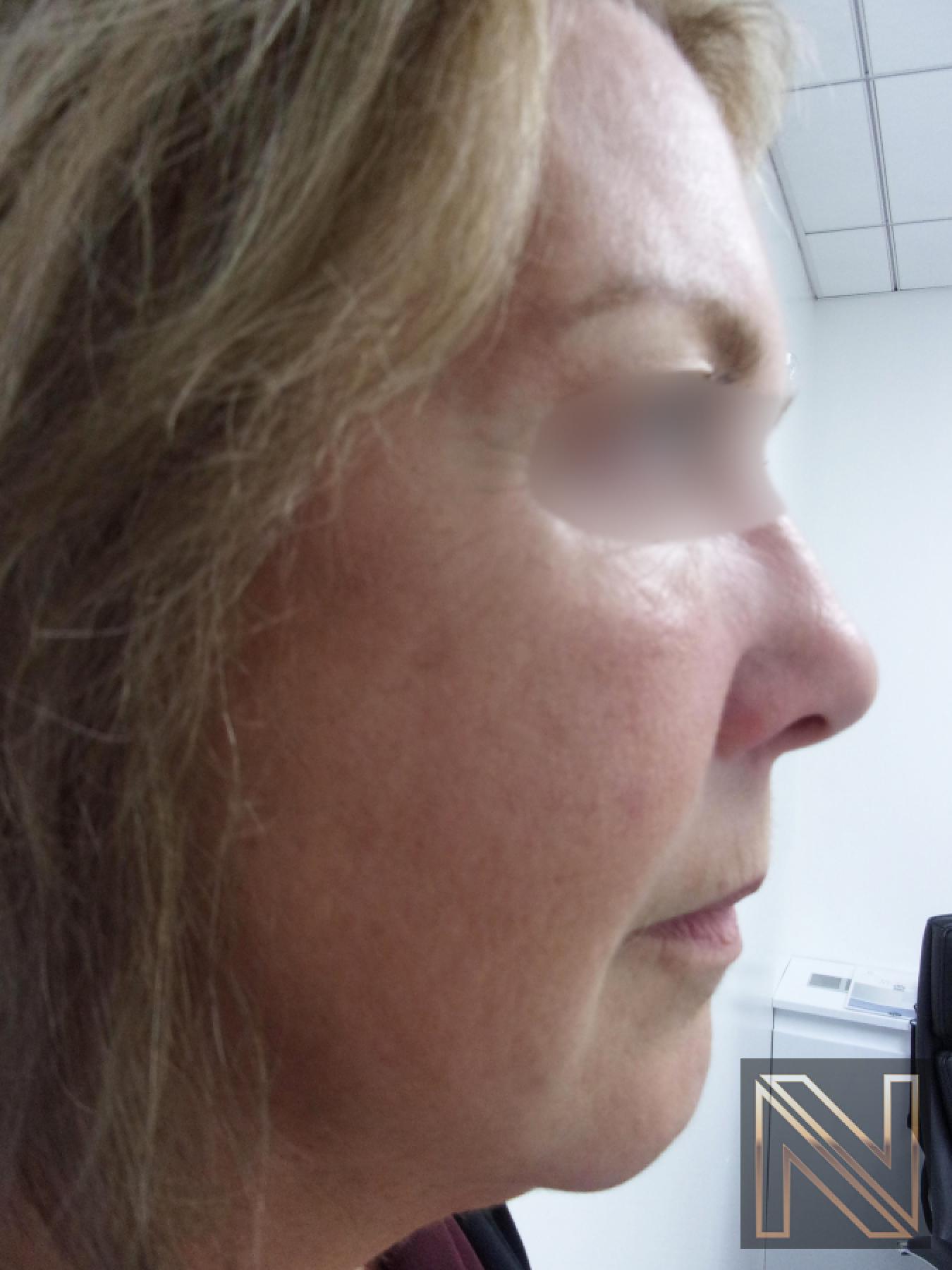Laser Skin Resurfacing - Face: Patient 1 - After 1