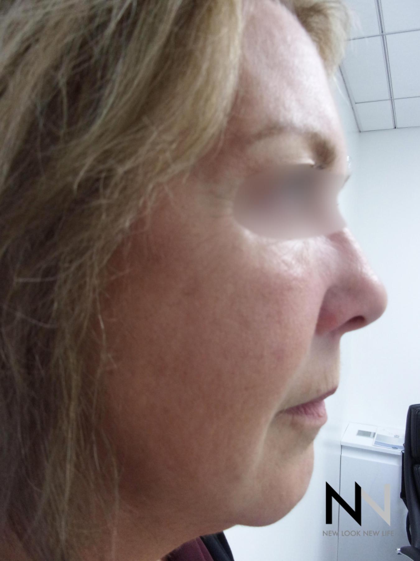 Laser Skin Resurfacing - Face: Patient 1 - After  